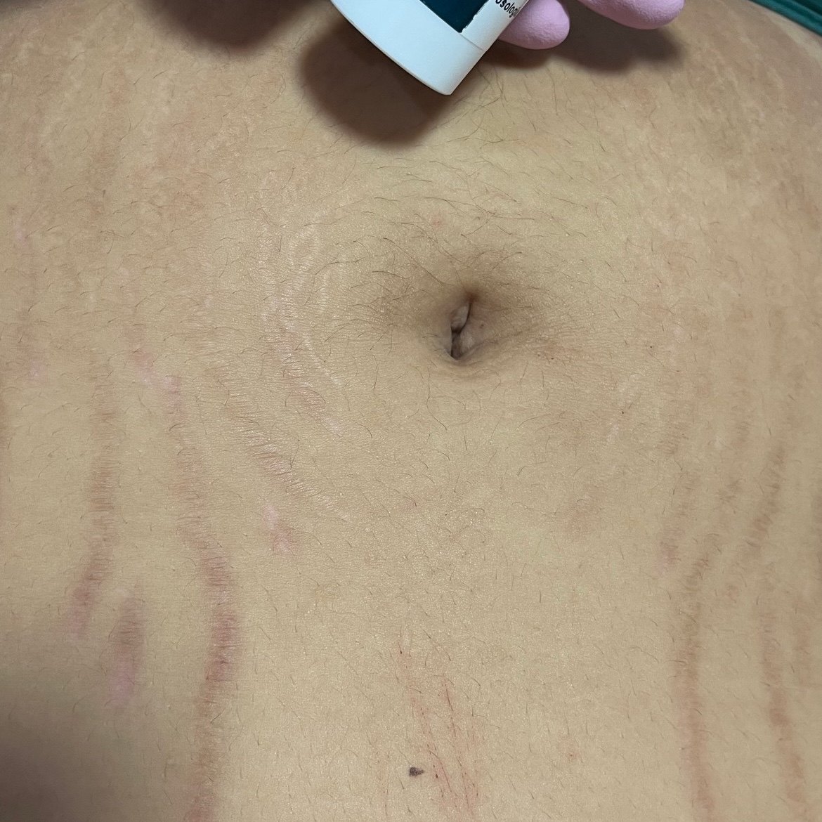 Camuflagem de estrias