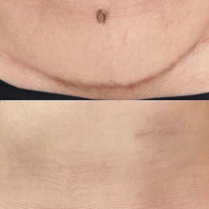 Camuflagem de cicatriz