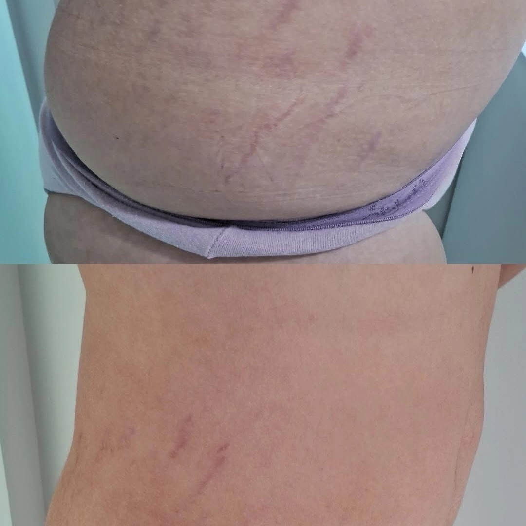 Tratamento NanoStrias