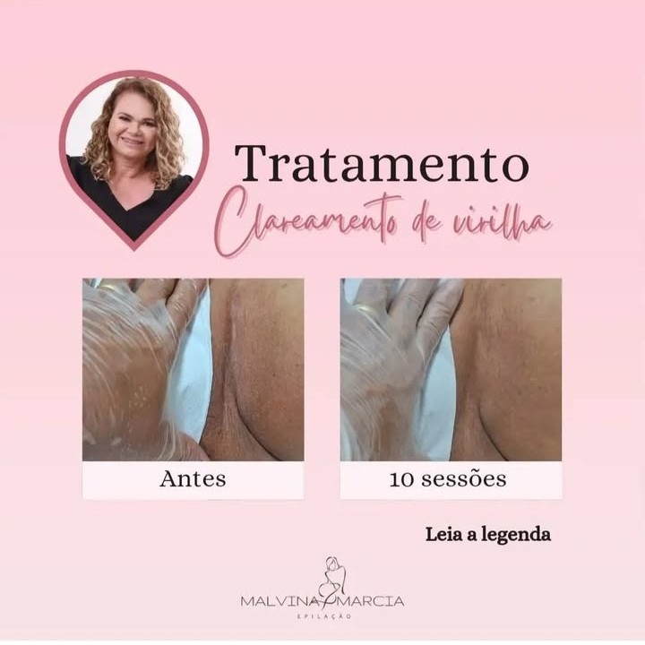 clareamento de áreas ( virilha)
