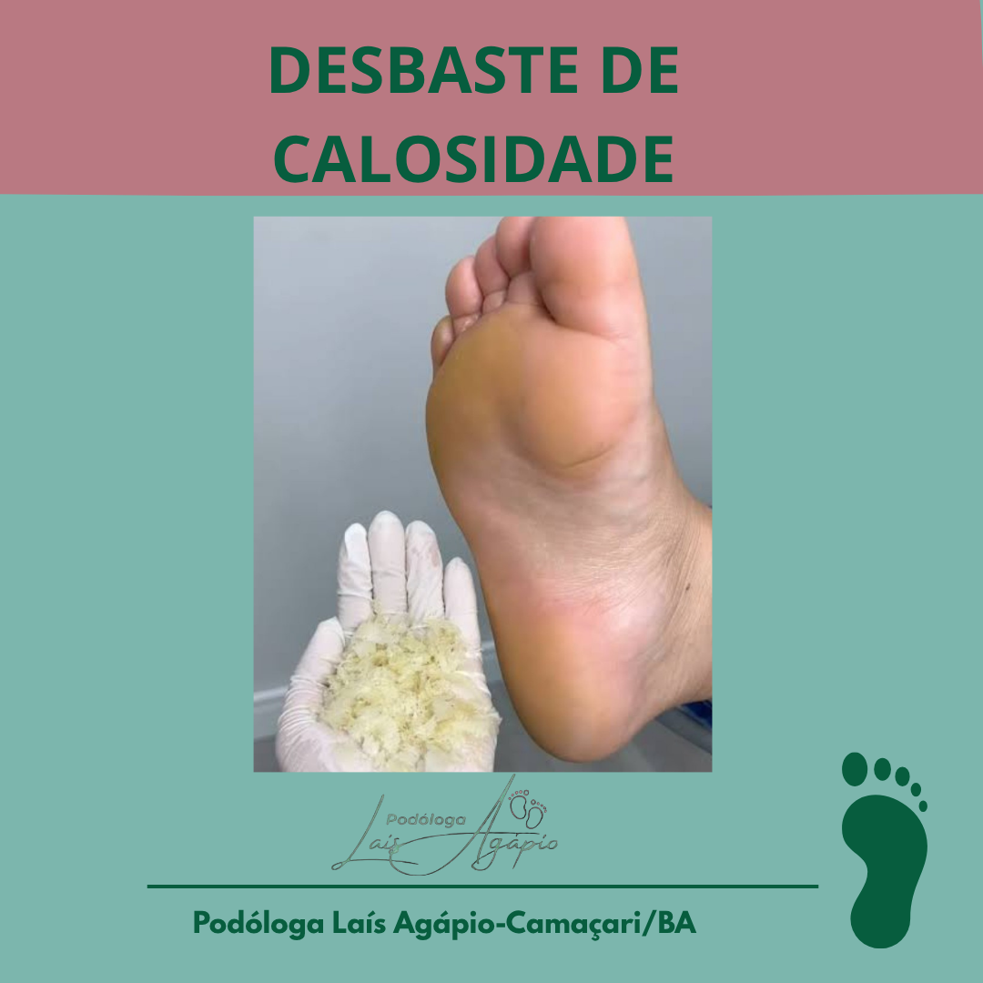 CALO/CALOSIDADE/RACHADURAS -Serviço realizado em Camaçari, Bahia.