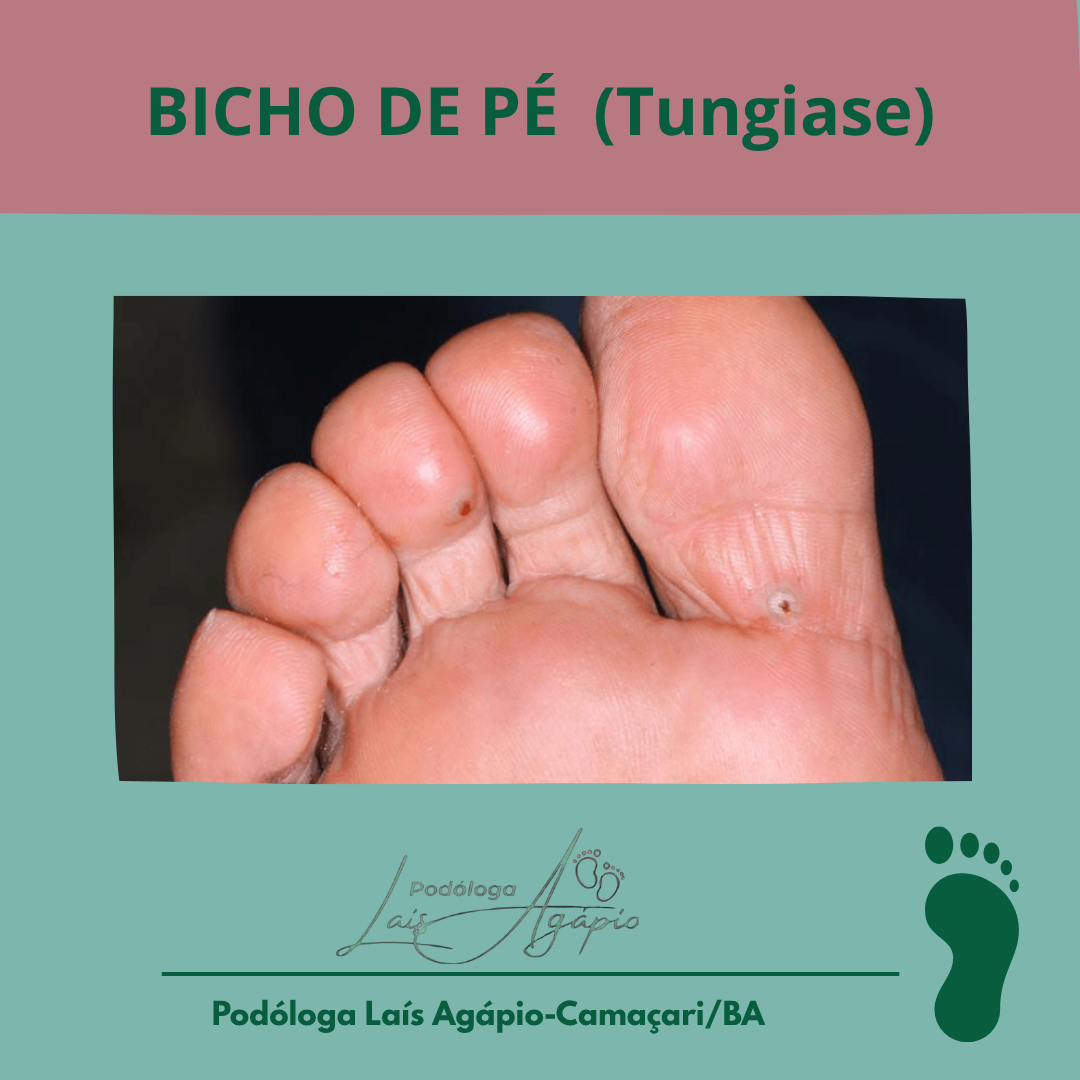 BICHO DE PÉ - Serviço realizado em Camaçari, Bahia.