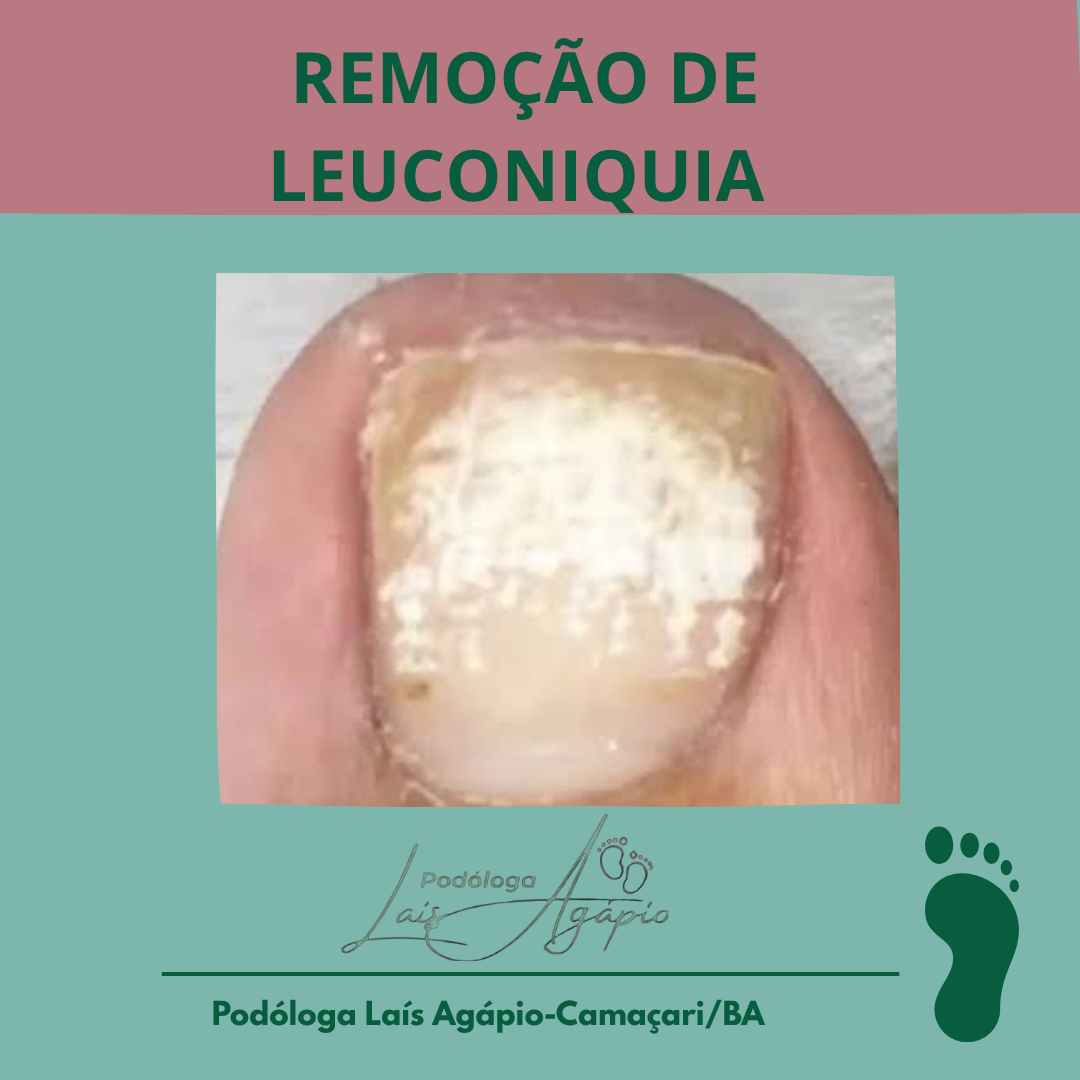 REMOÇÃO DE LEUCONIQUIA - Serviço realizado em Camaçari, Bahia.