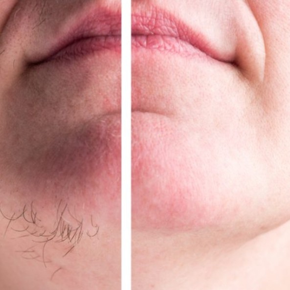 Depilação do Queixo