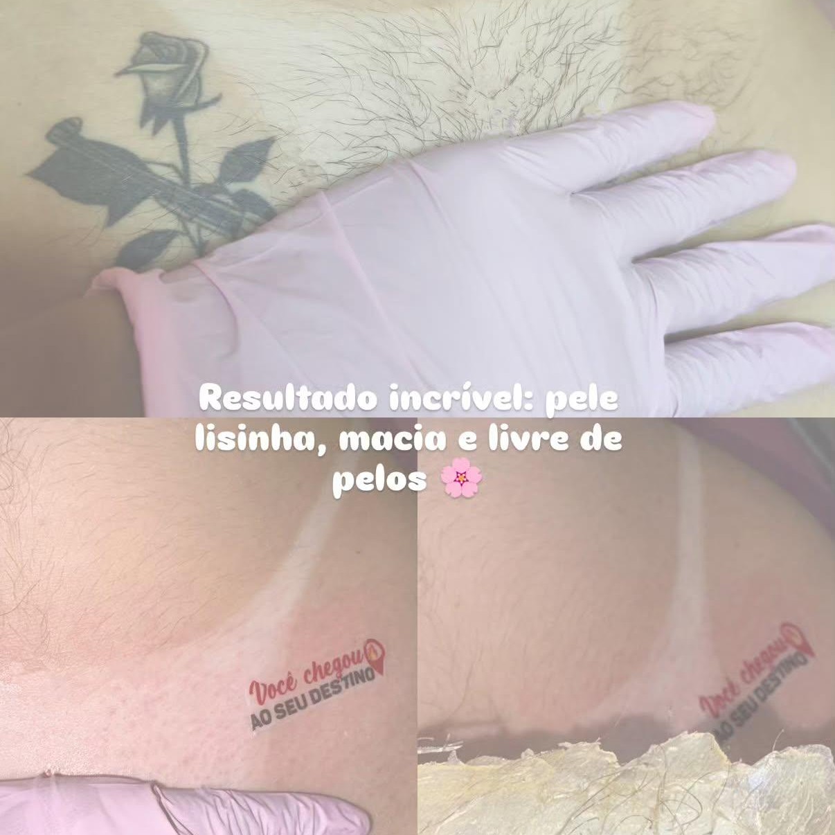 Epilação íntima completa