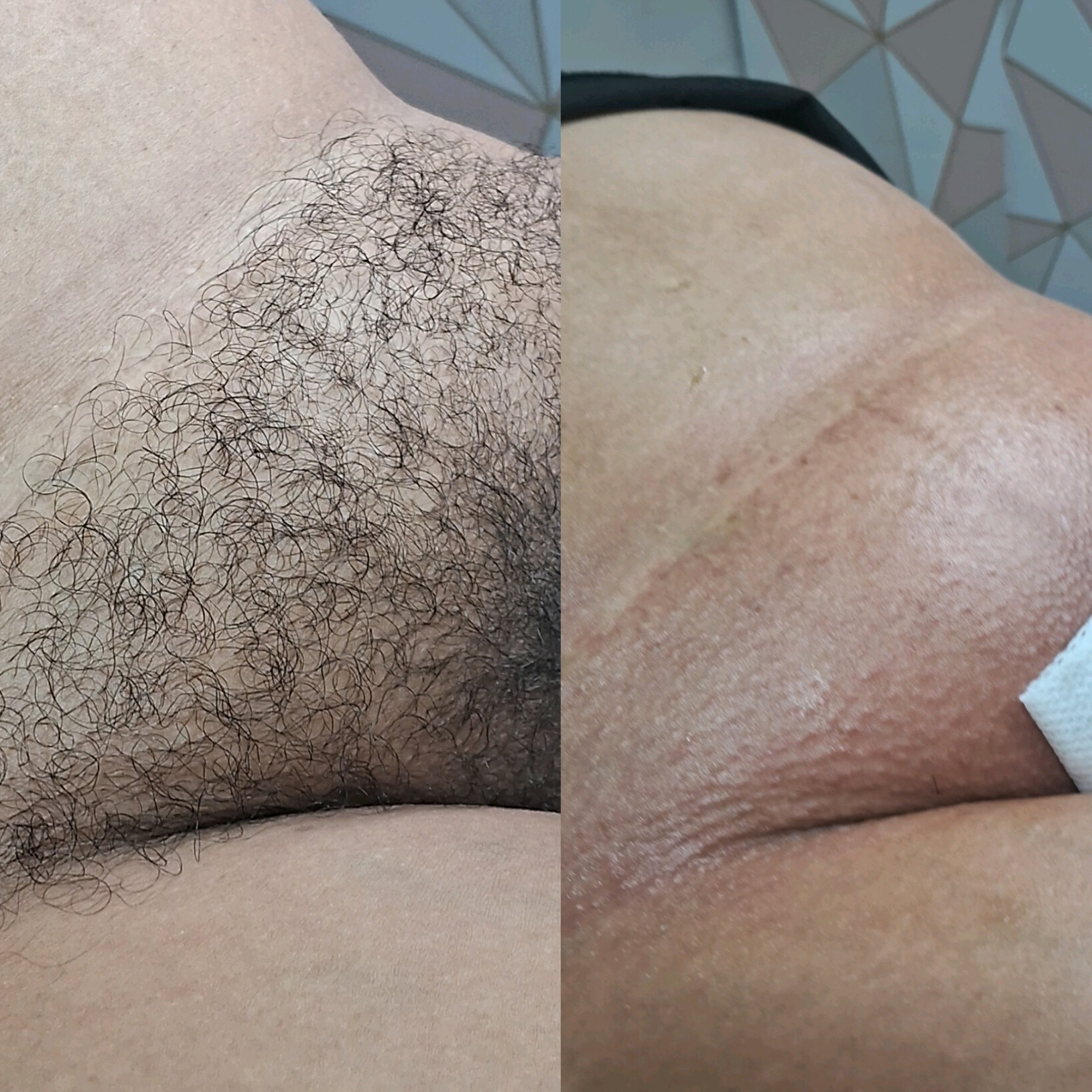 Depilação intima completa