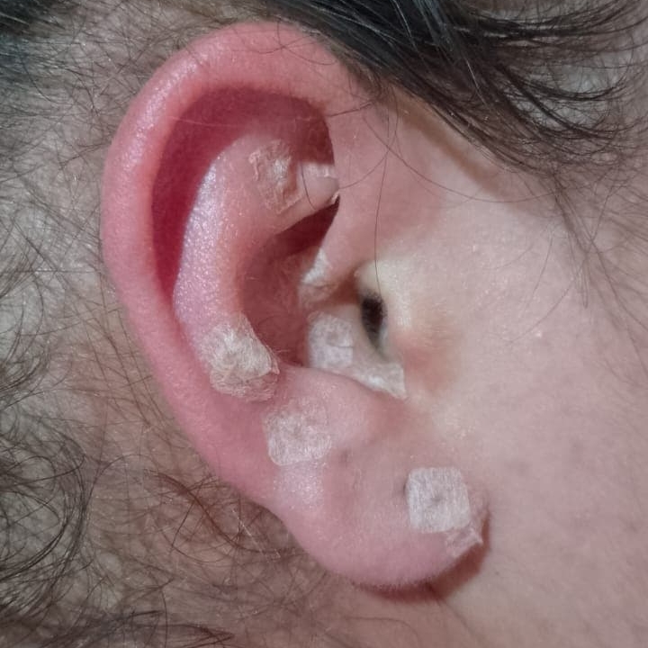 Auriculoterapia (4 sessões)