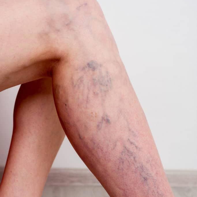 PEIM (microvasos) + Drenagem linfática local 1 sessões