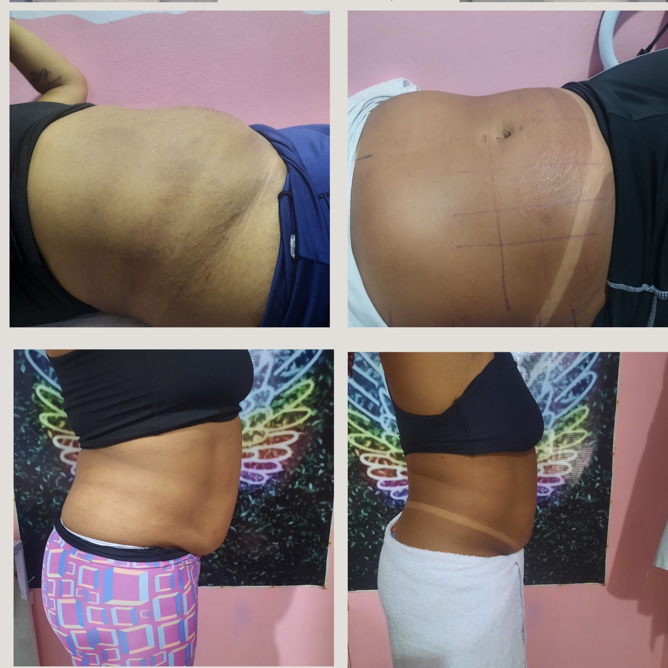 Aplicação de enzima