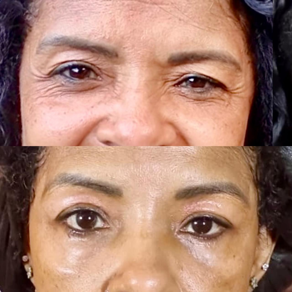 2 - Jato de Plasma ( região )  Pálpebra Superior / Pálpebra Inferior / Testa / Obs: a sessão do jato de plasma só é feita após a preparação da pele no valor de 150