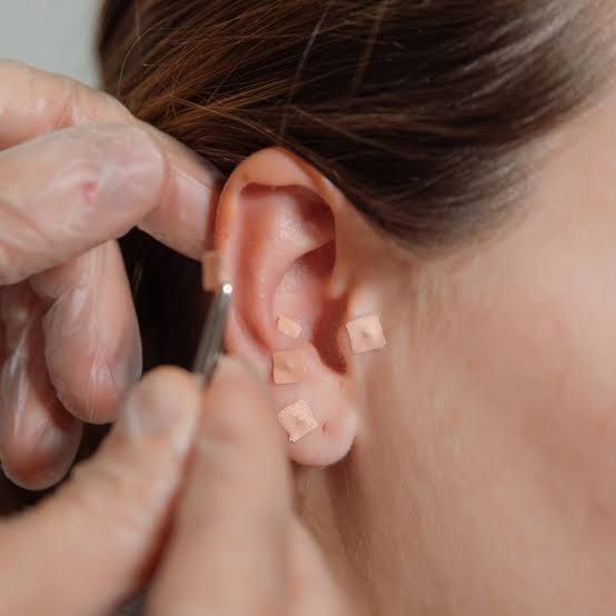 Auriculoterapia
