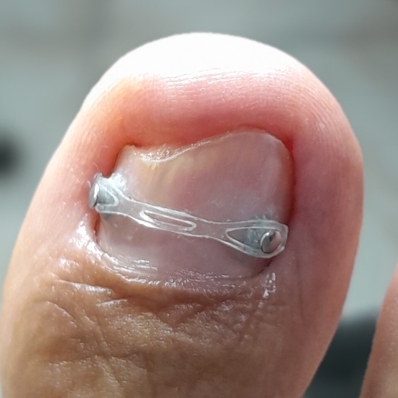 Orteses Ungueal (Correção da Unha)