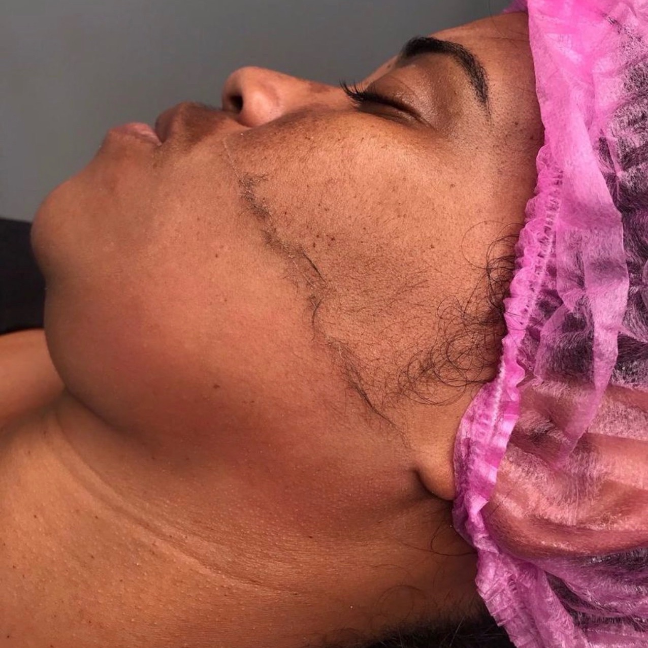 Dermaplaning limpeza rosto