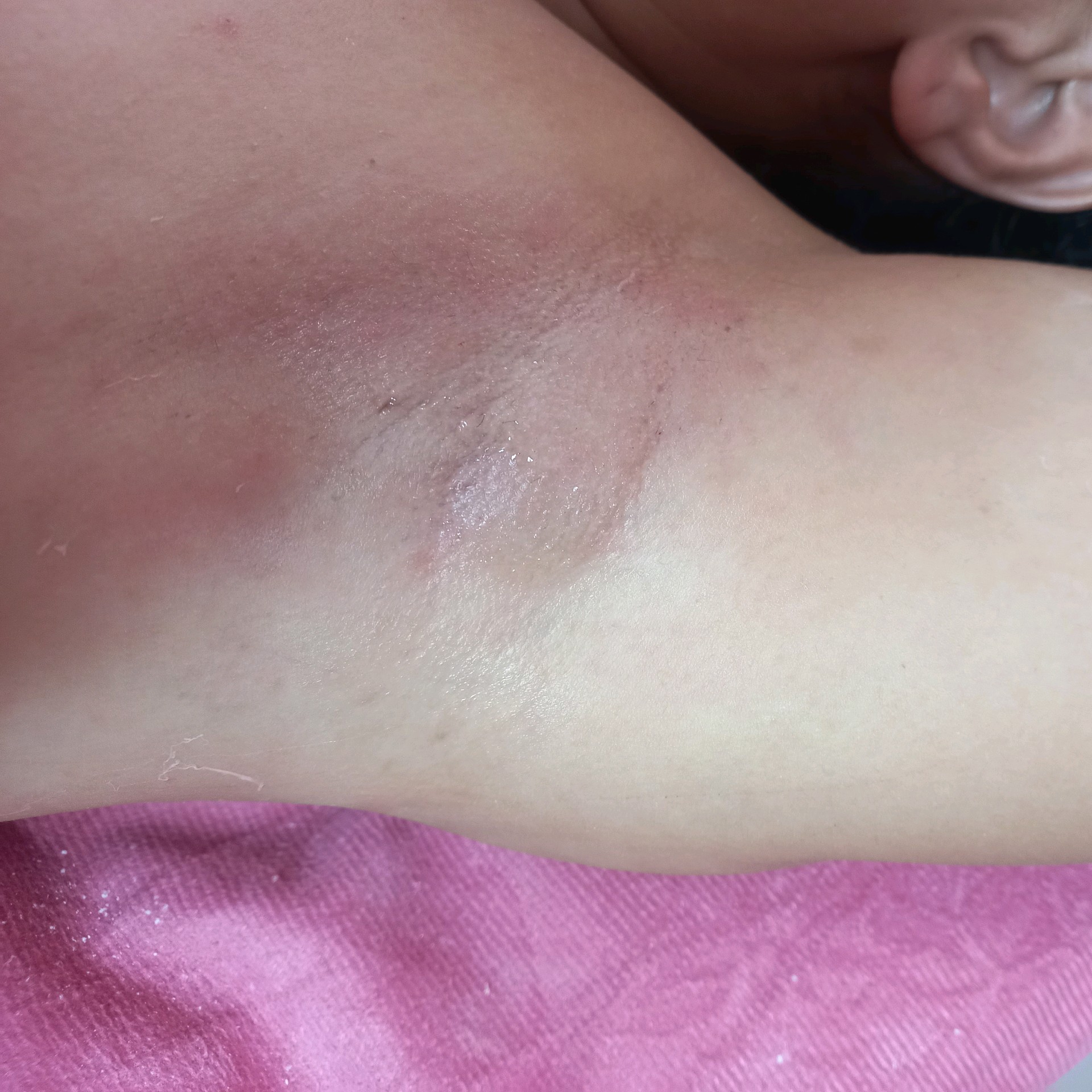 Epilação de axilas