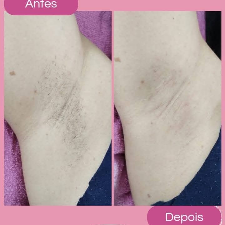 depilação de axilas feminina