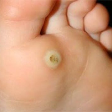 Tunga penetrans( bicho de pé )