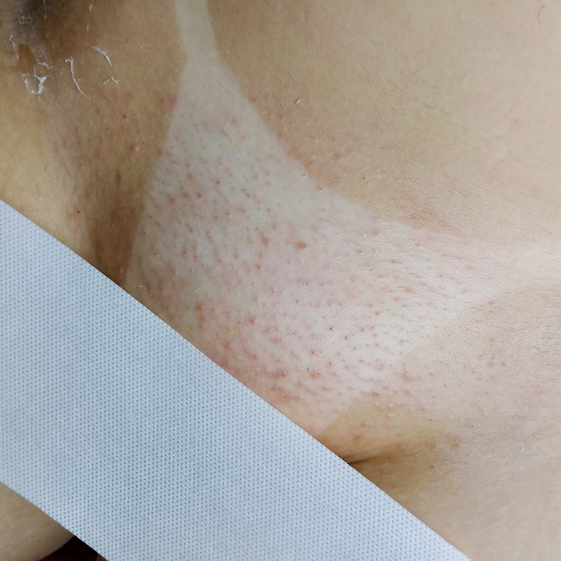 Virilha total (ânus)