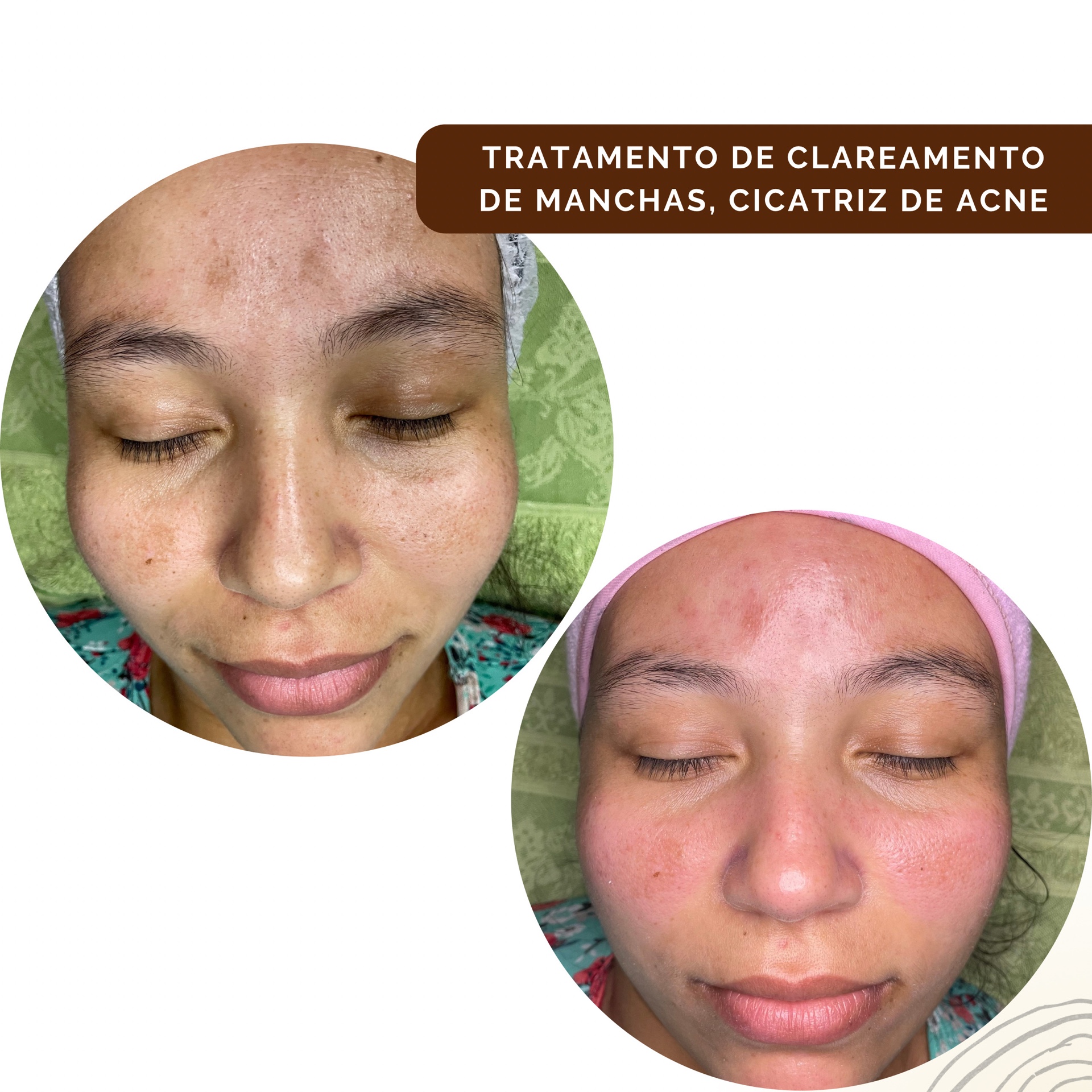 Clareamento + Home Care