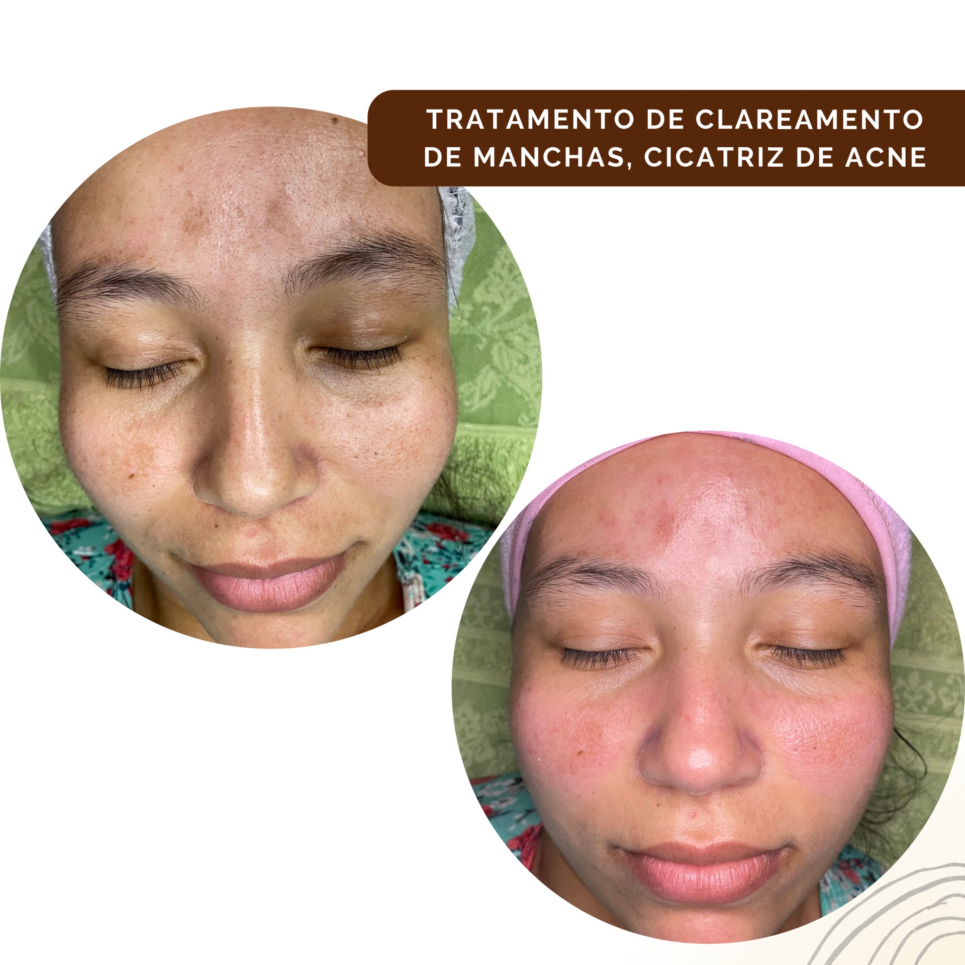 Clareamento de Melasma