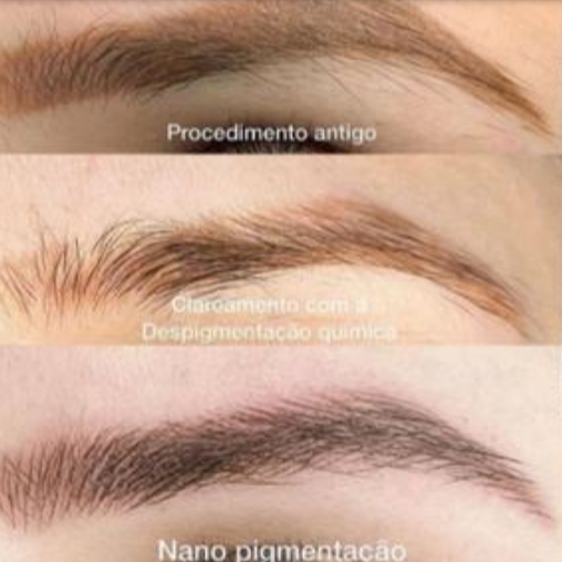 Despigmentação Química