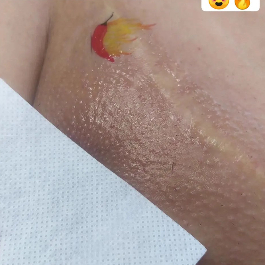 Epilação Virilha frontal