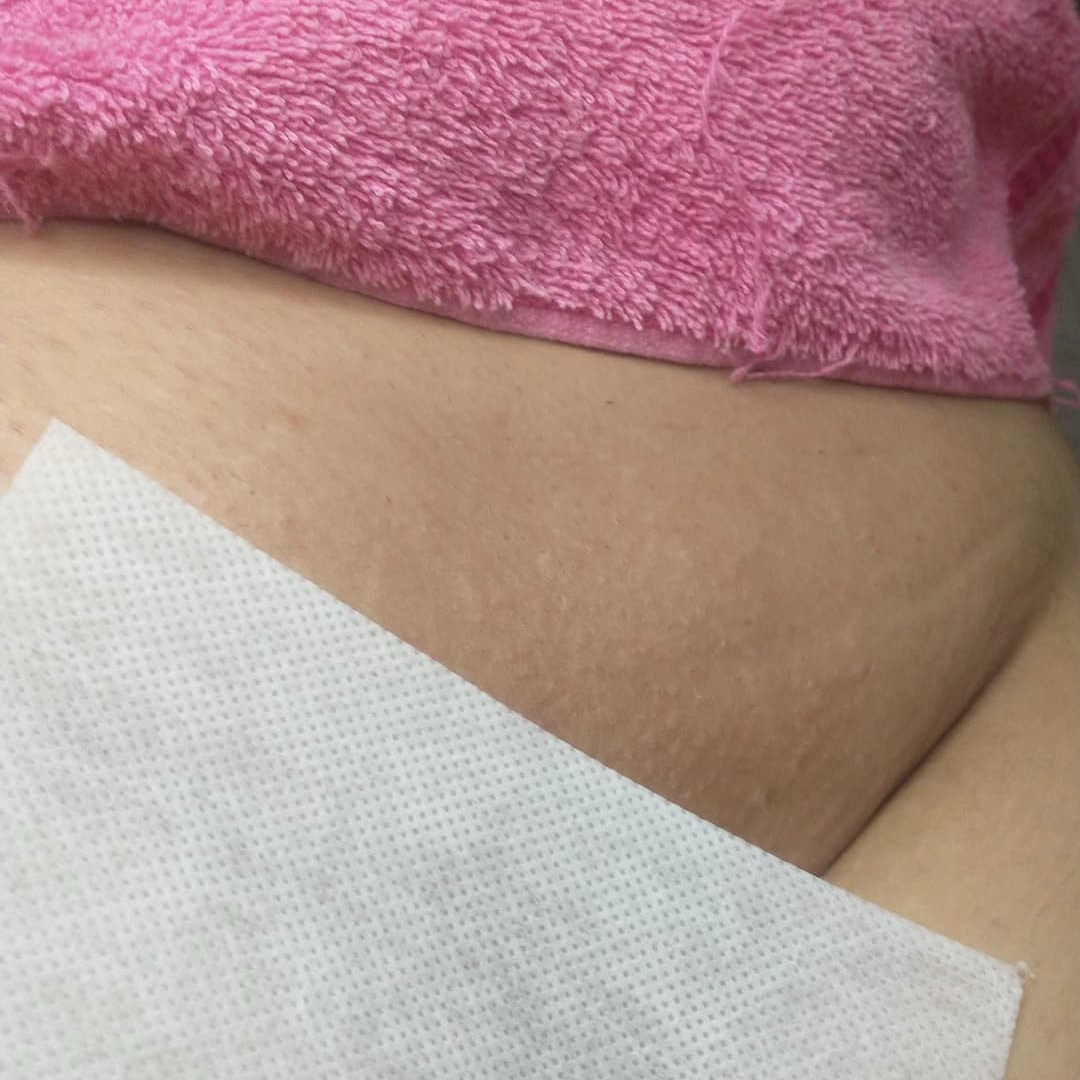 Spa íntimo+clareamento 4 sessões