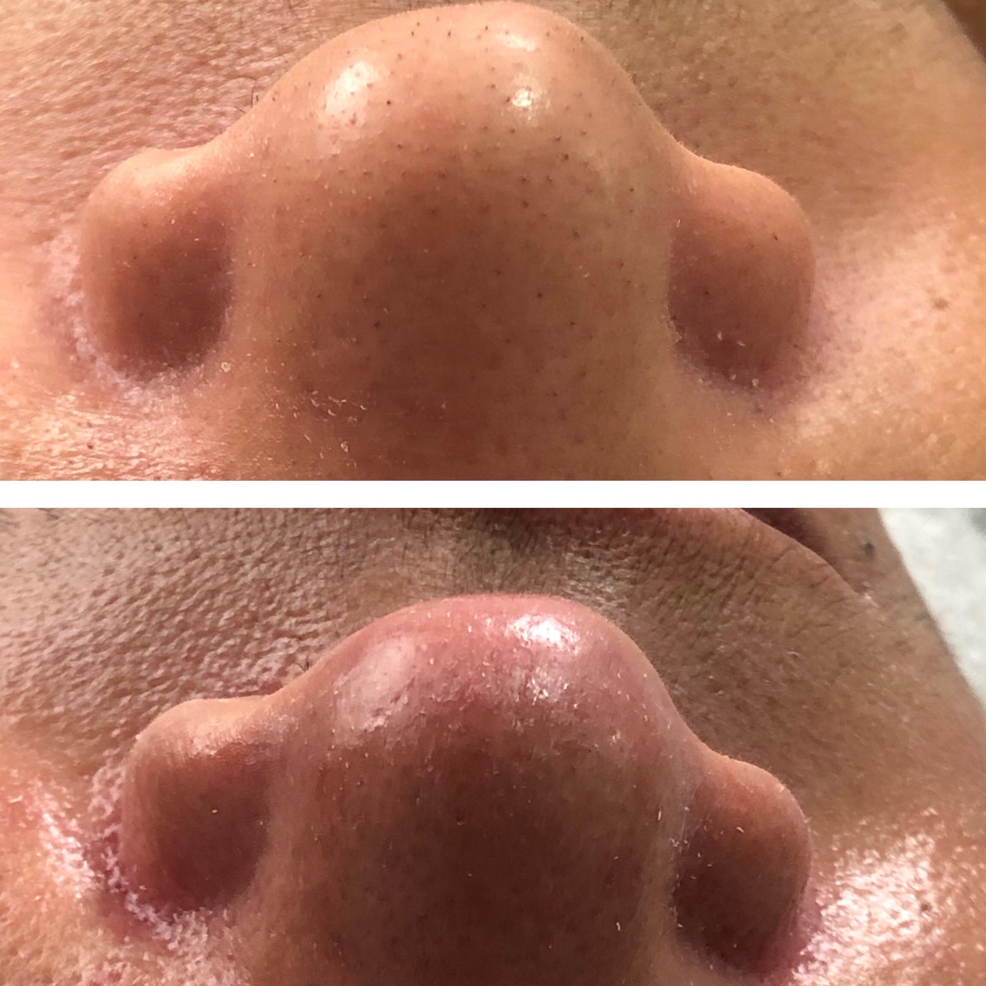 Limpeza de Pele Fotobiomodulada