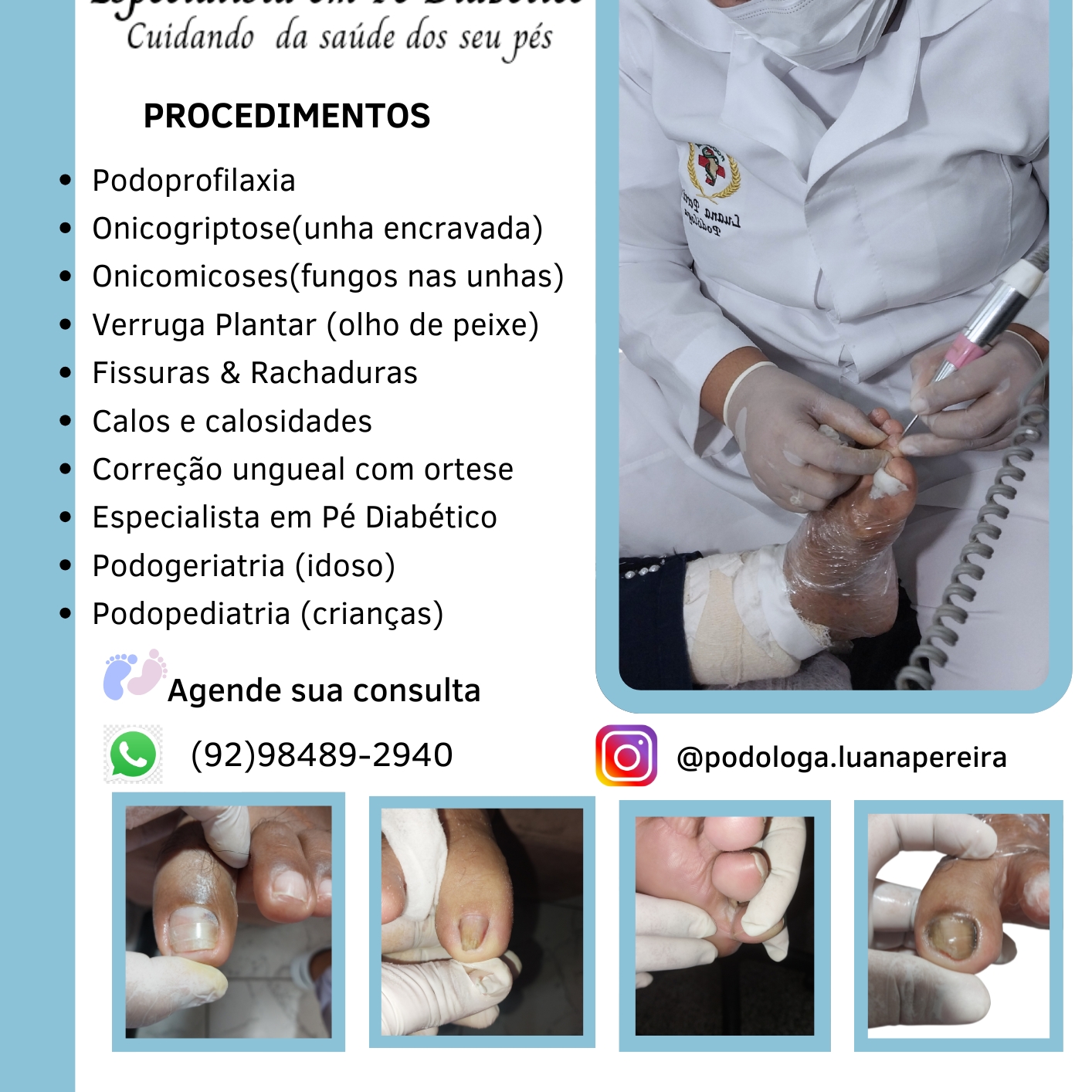 Remoção  de verruga plantar(olho de peixe)