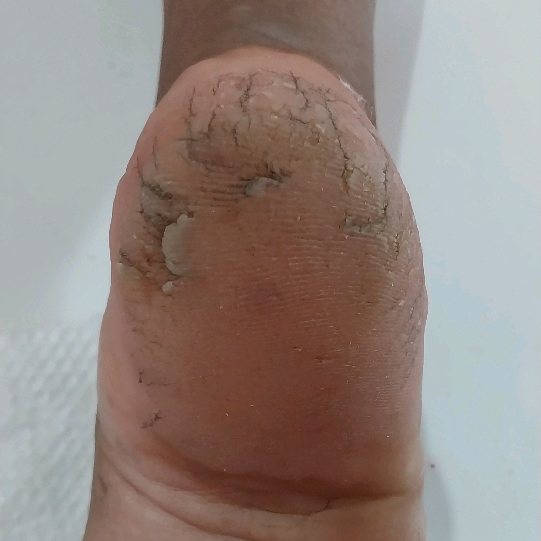 tratamento de calos e calosidades e fissuras