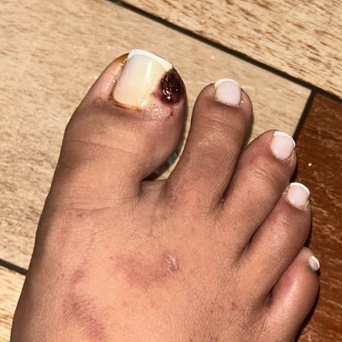 Tratamento  de unha encravada