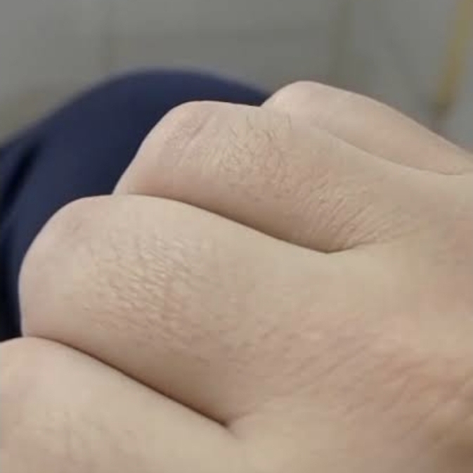 Epilação churreia ou chureula.