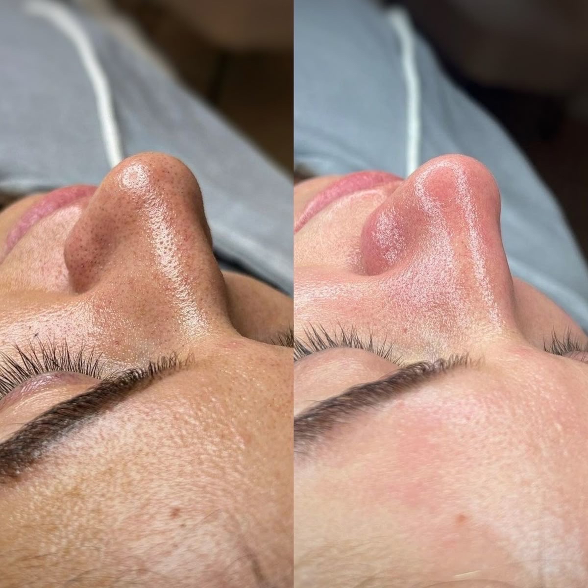 Limpeza de pele simples