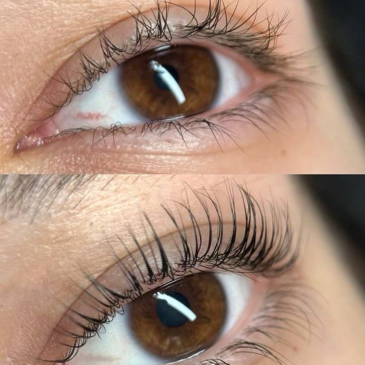 LASH lifting