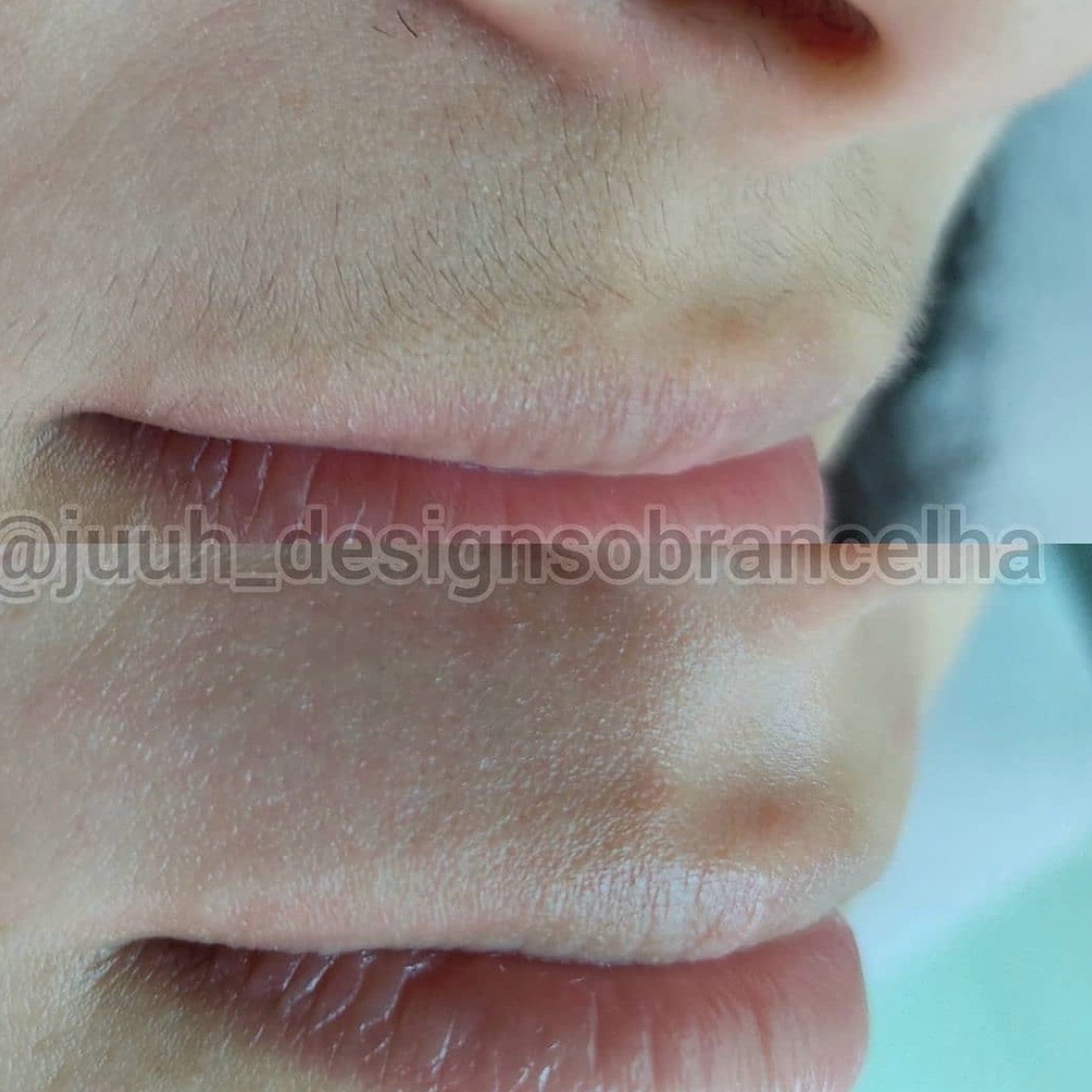 Epilação com Linha