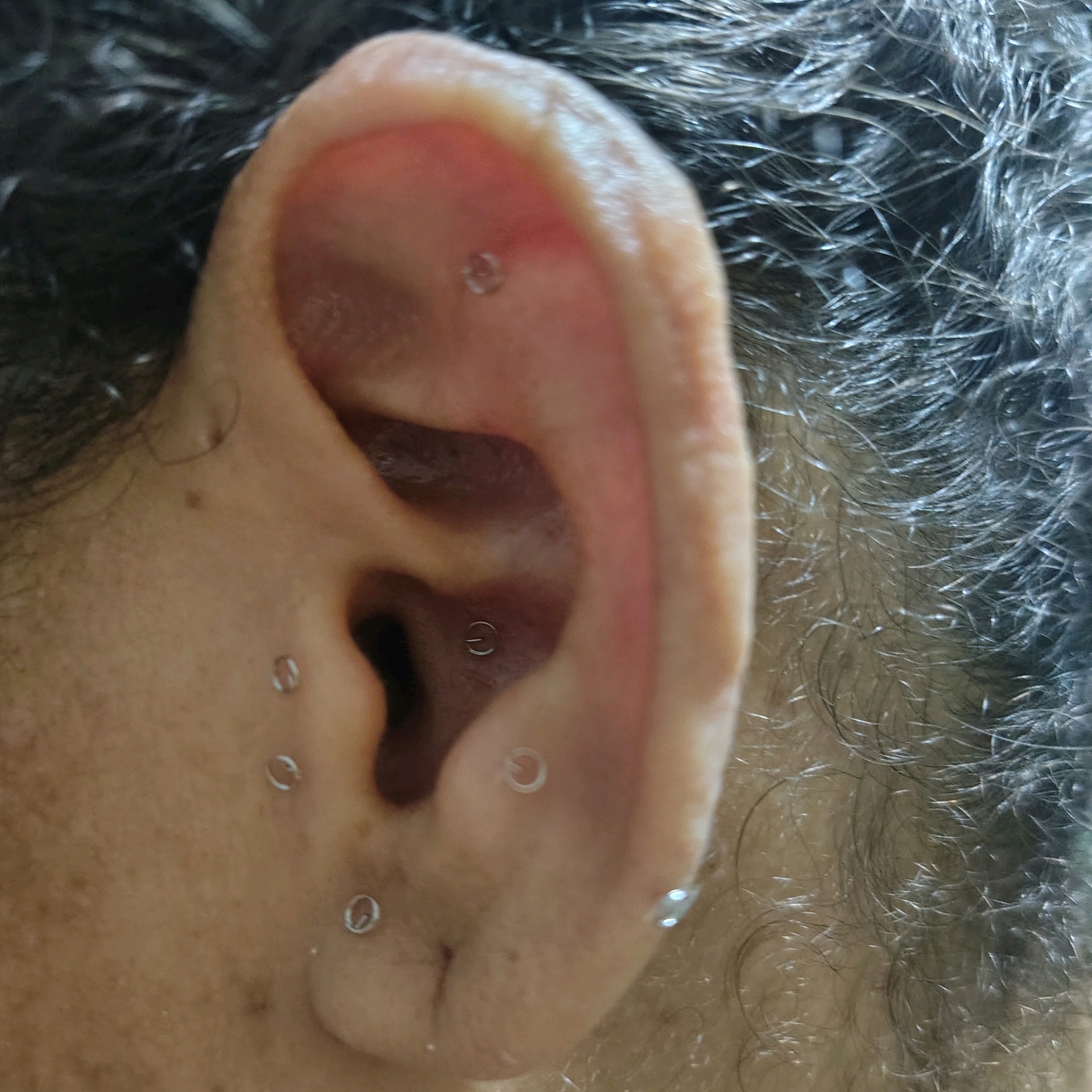 Auriculoterapia com microagulhas semipermanentes (com anamnese)