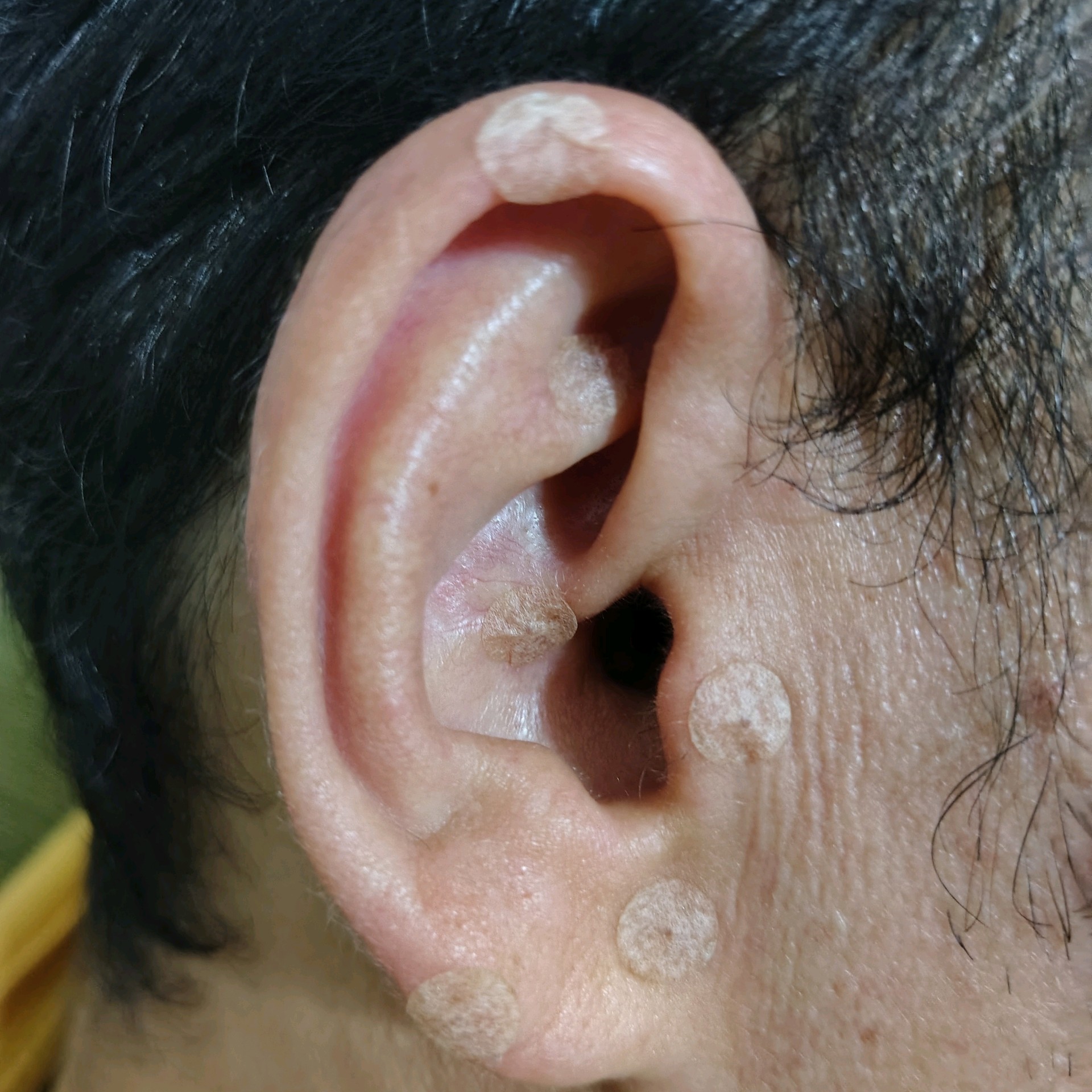 Auriculoterapia com sementes ou cristais (com anamnese)