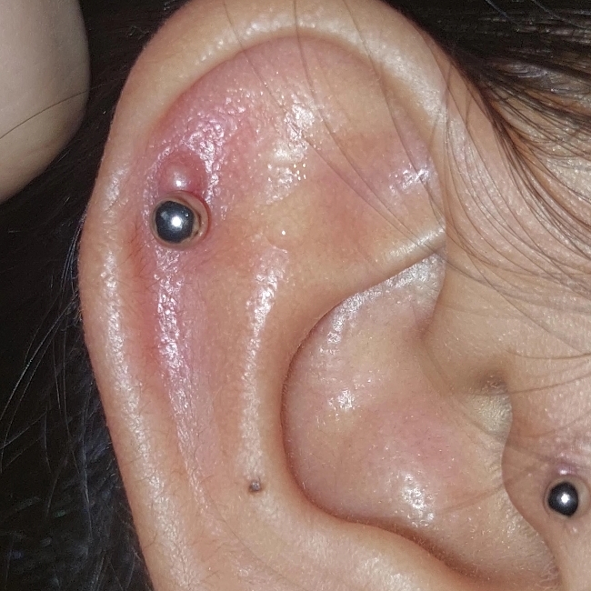 Tratamento Granuloma