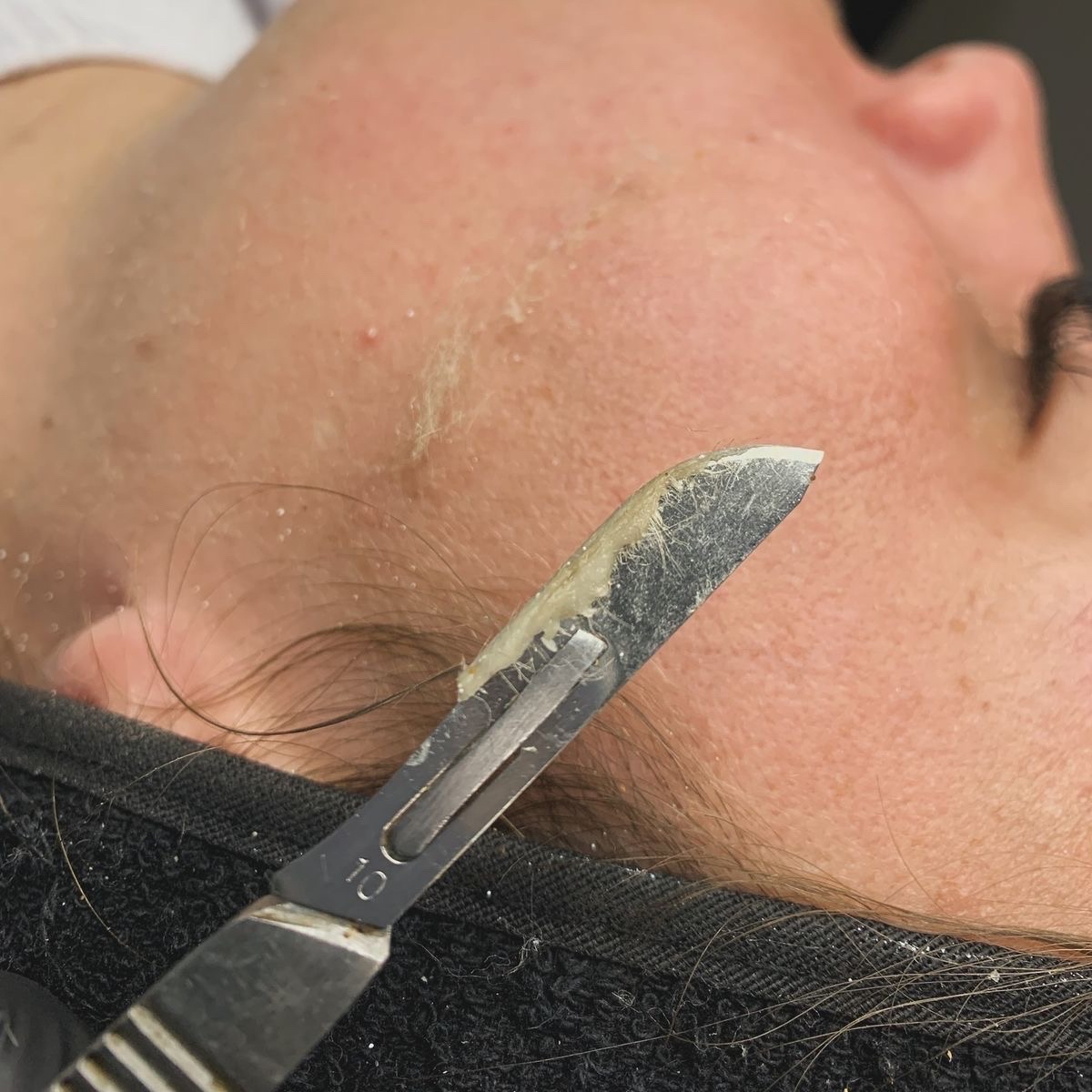 Dermaplaning