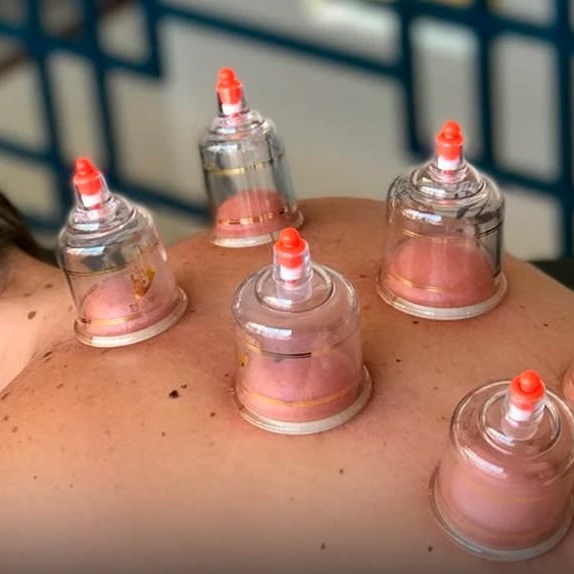 Ventosaterapia.....ele visa a melhorar a circulação sanguínea