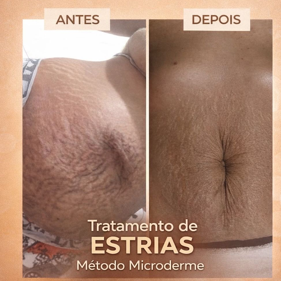 tratamento para estrias