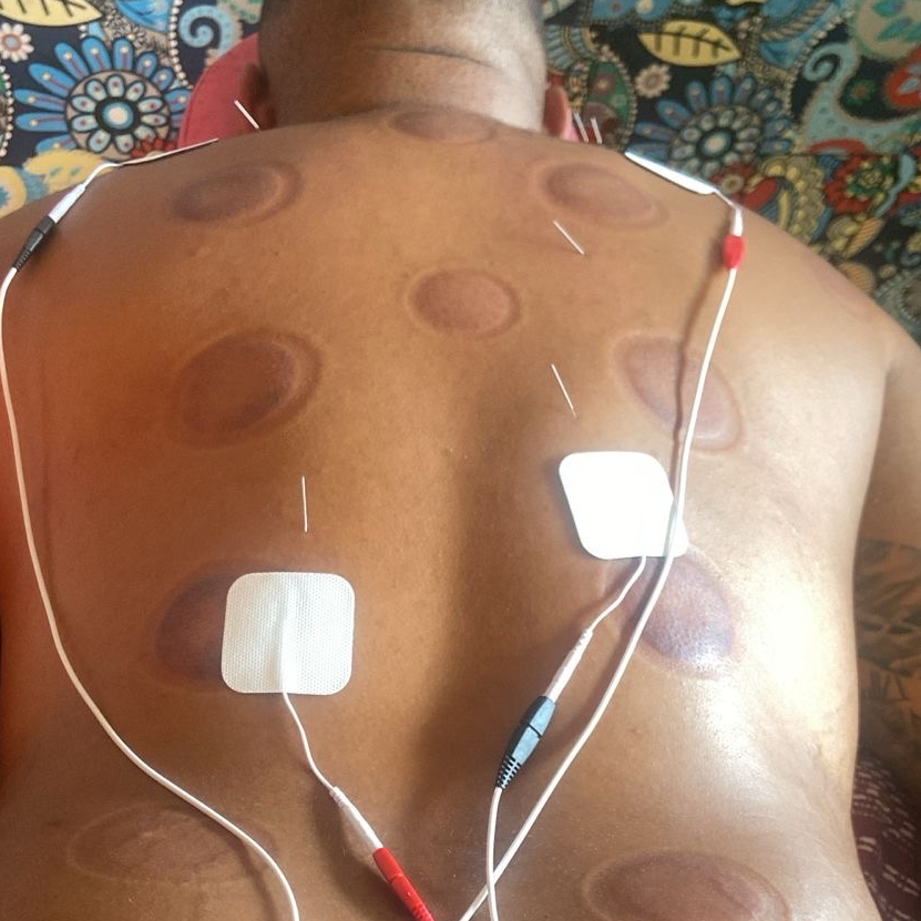 liberação miofacial