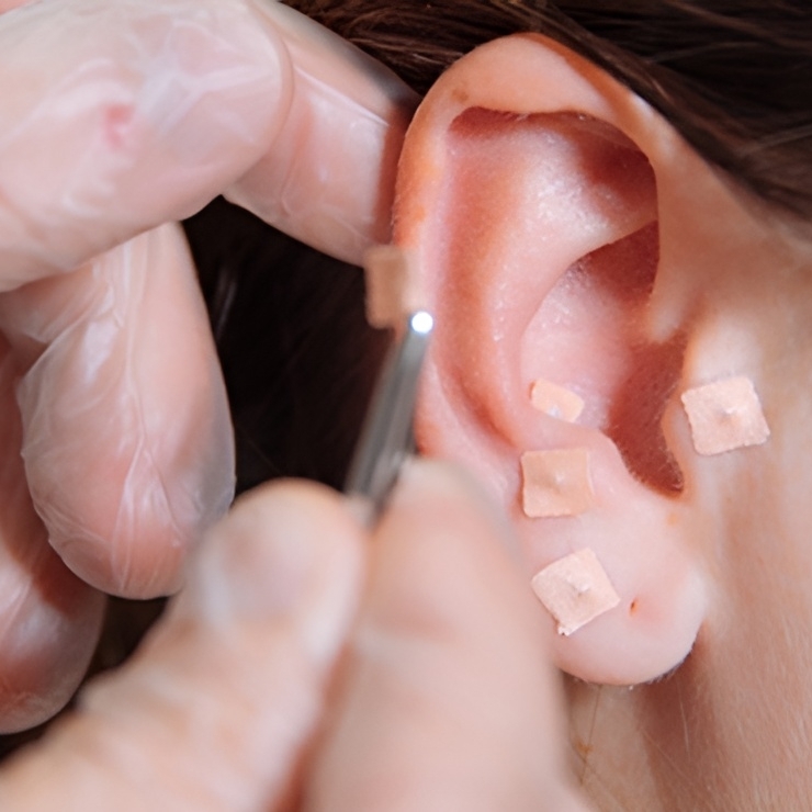 auriculoterapia utiliza a estimulação de pontos específicos na (orelha) para tratar dores, distúrbios físicos, mentais e emocionais.