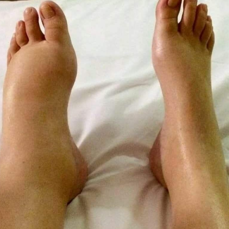 drenagem linfática.....indicada para reduzir inchaços (edemas), melhorar a circulação, auxiliar no pós-operatório acelerando a eliminação de líquidos, toxinas.(pacotes 10) (sessão)