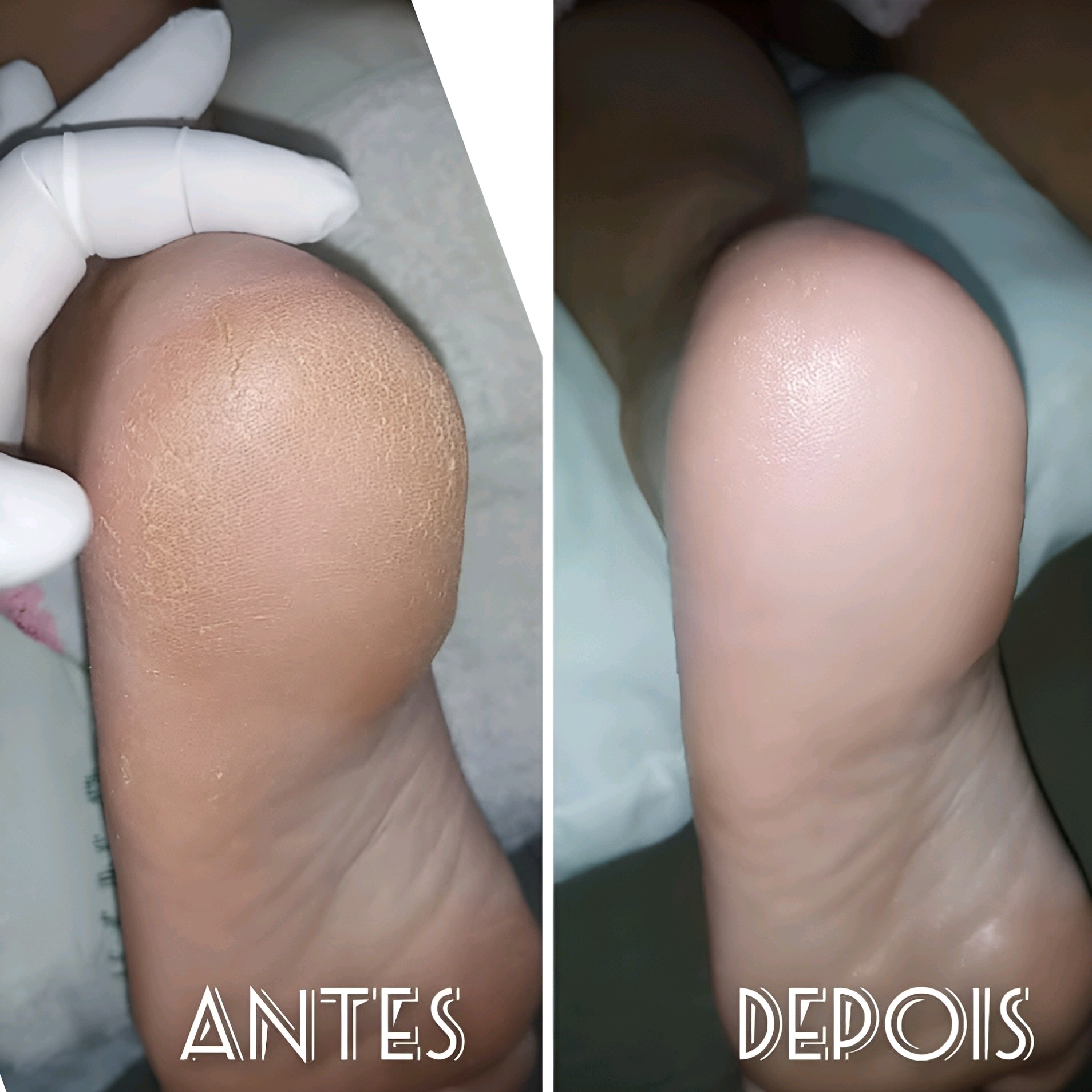 SPA dos Pés foca em relaxamento, hidratação e bem-estar, usando escalda-pés com água morna, sais e esfoliação. A plástica dos pés é um tratamento intenso para remover calosidades, rachaduras e células mortas, renovando a pele...(valores diferentes)