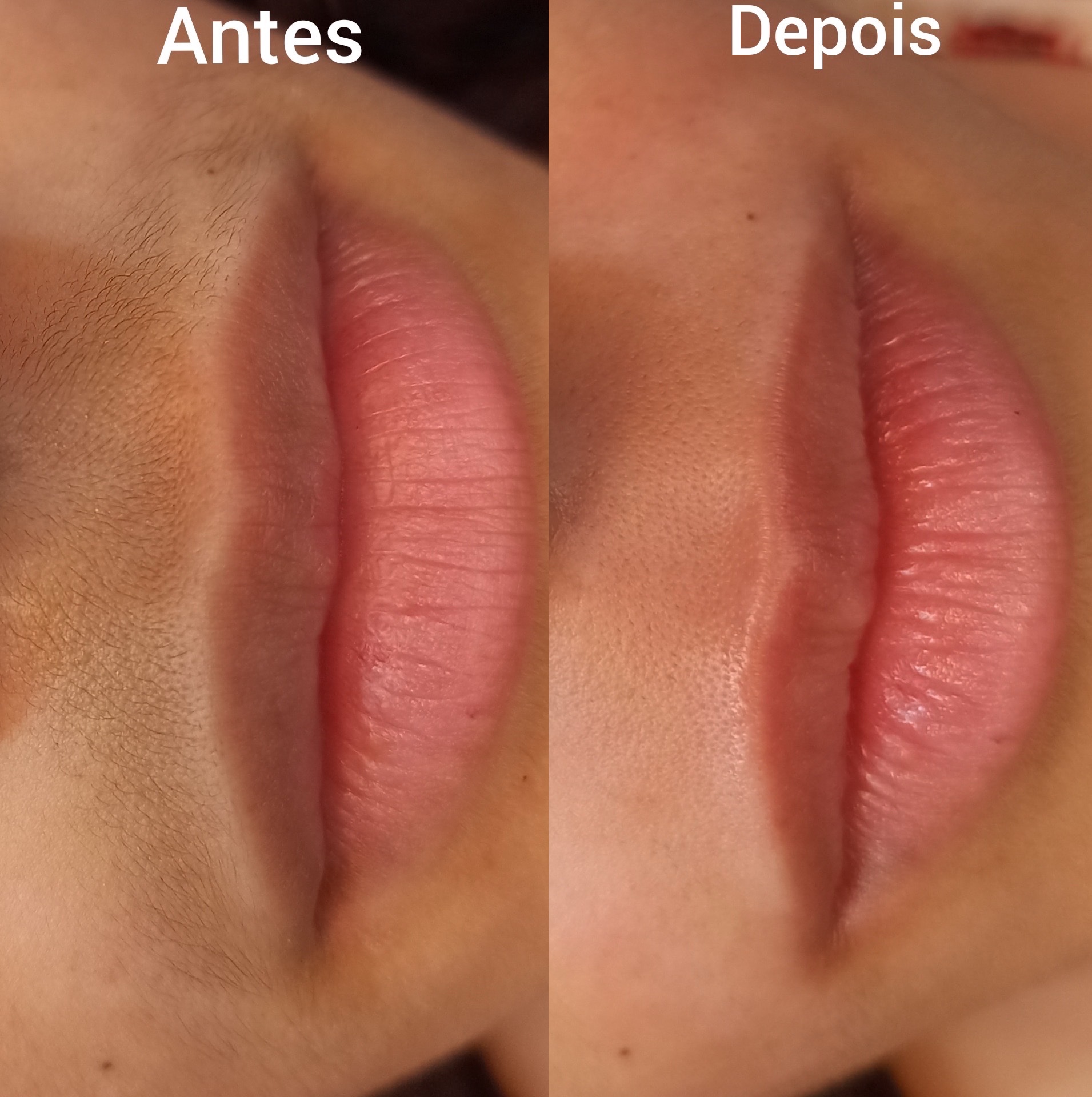 Epilação de buço