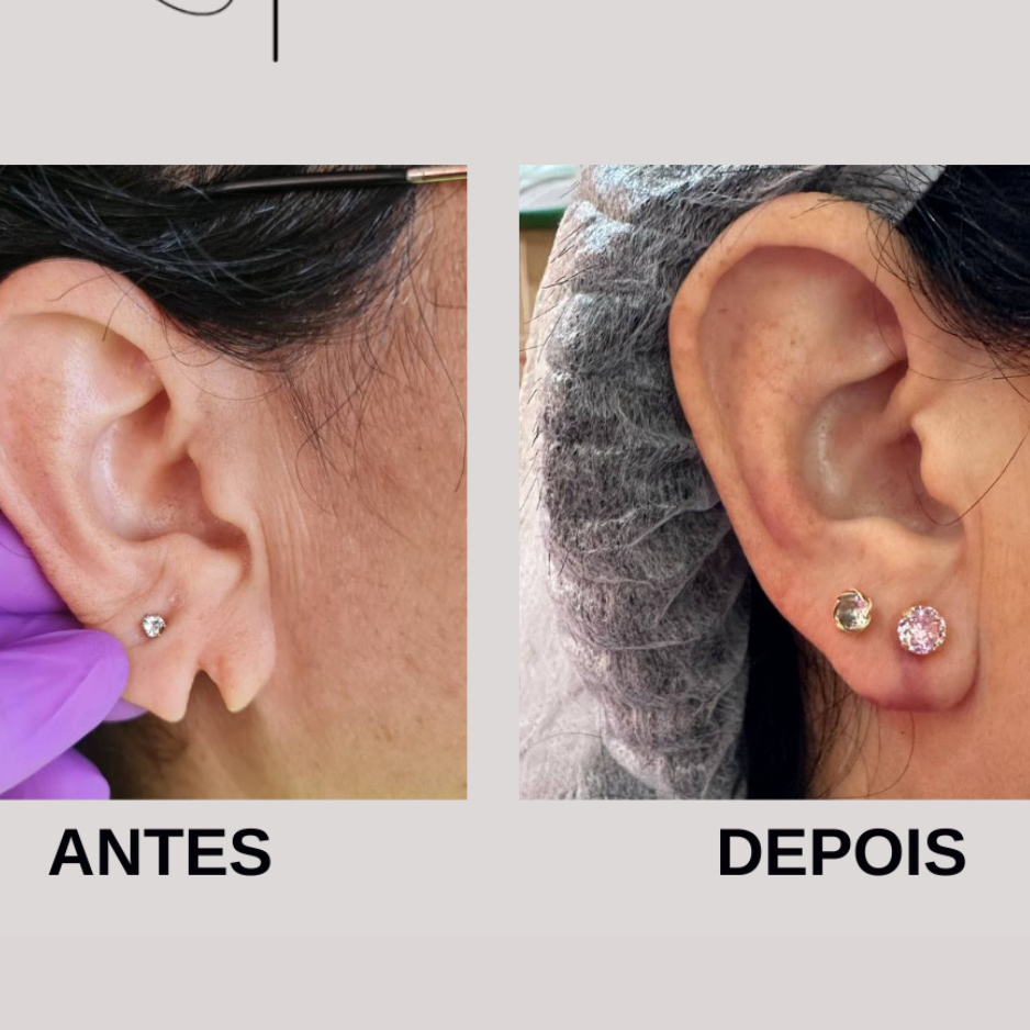 Lobuloplastia não cirurgica