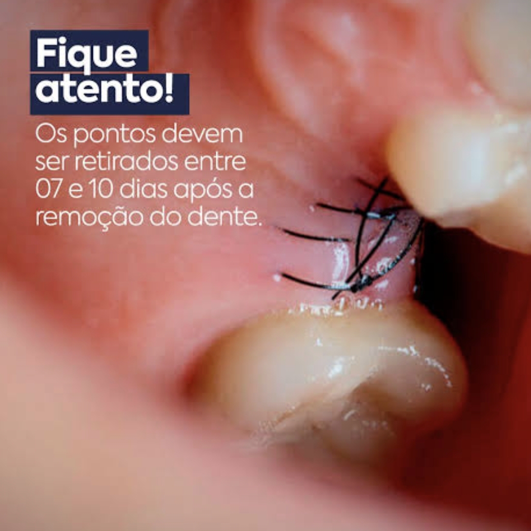 Remoção de Ponto