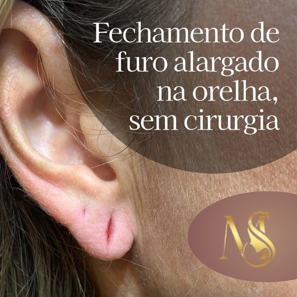 Lobuloplastia / fechamento de fenda na orelha