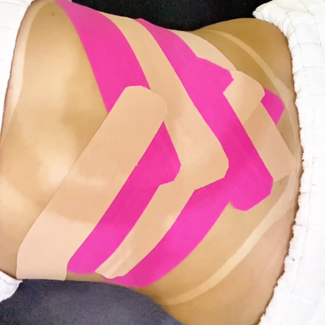 Aplicação de tape para DIÁSTASE com massagem redutora.