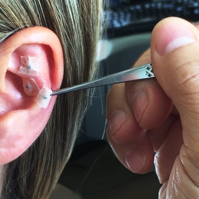 Auriculoterapia avaliação